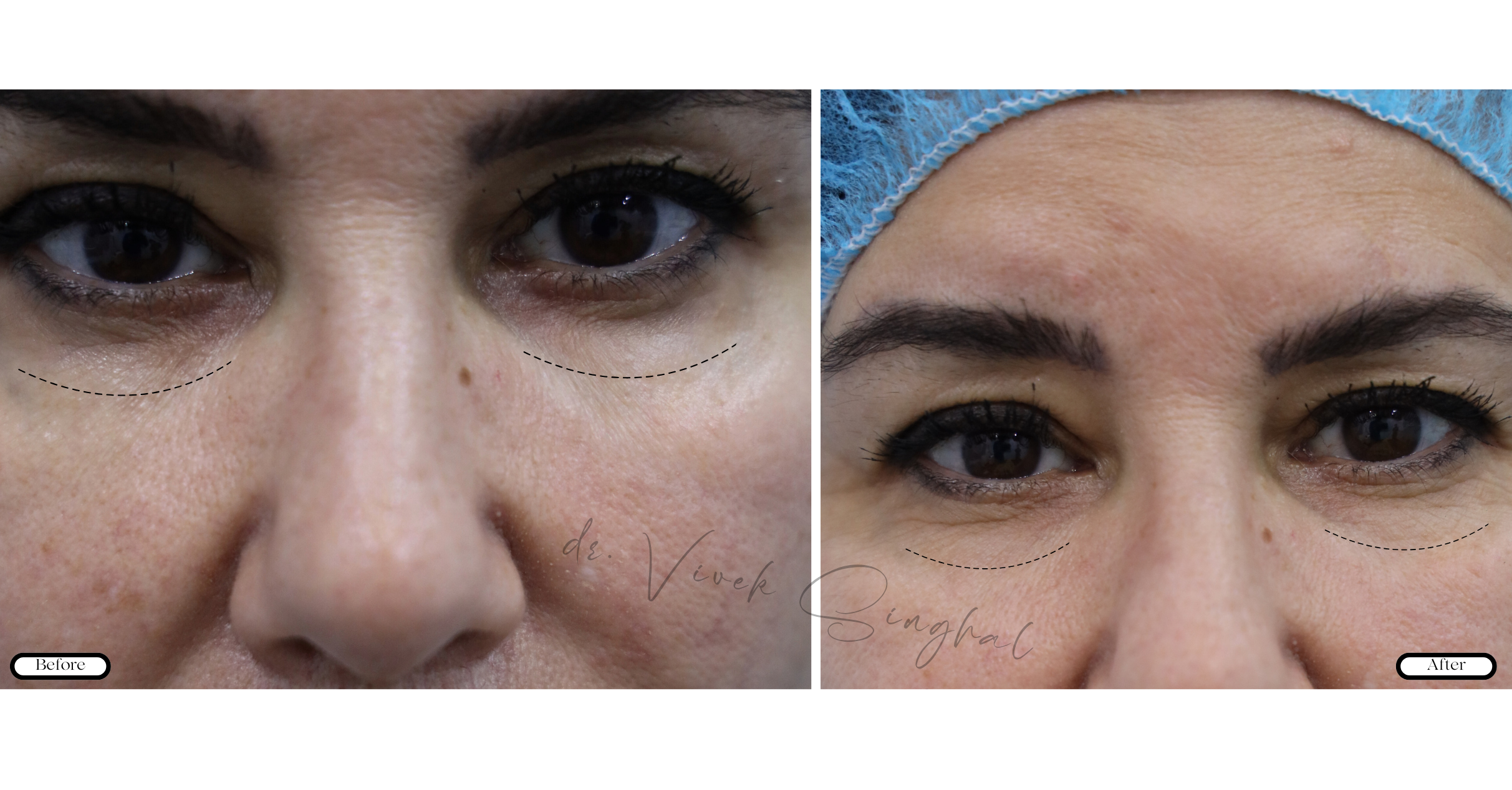 Filler Treatment