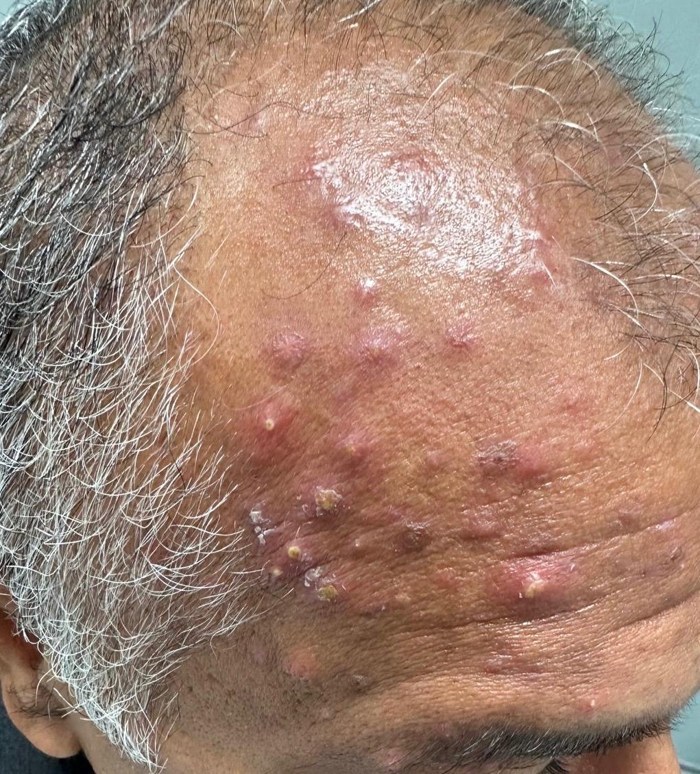 Skin Disorder