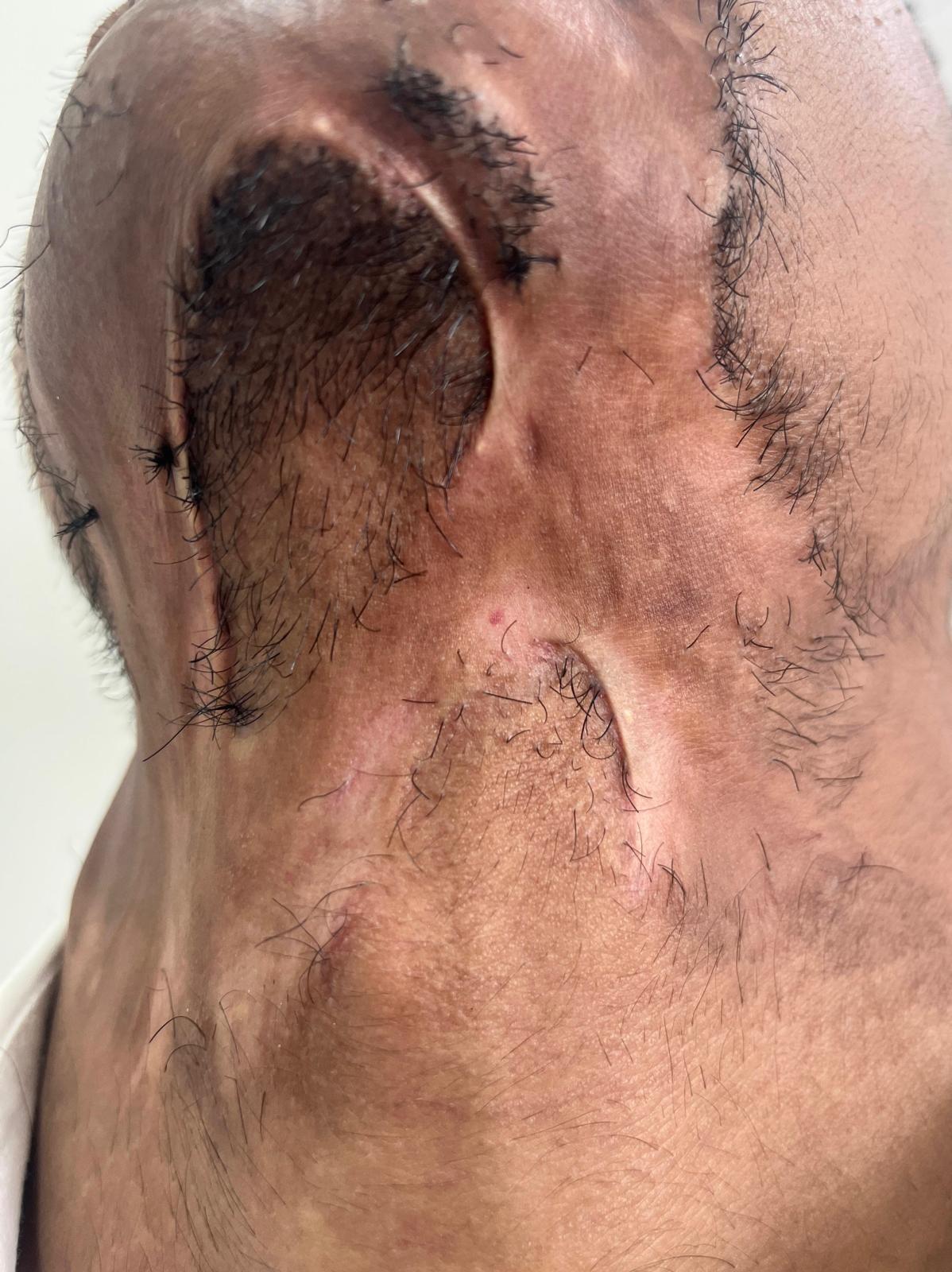 Scar treatment