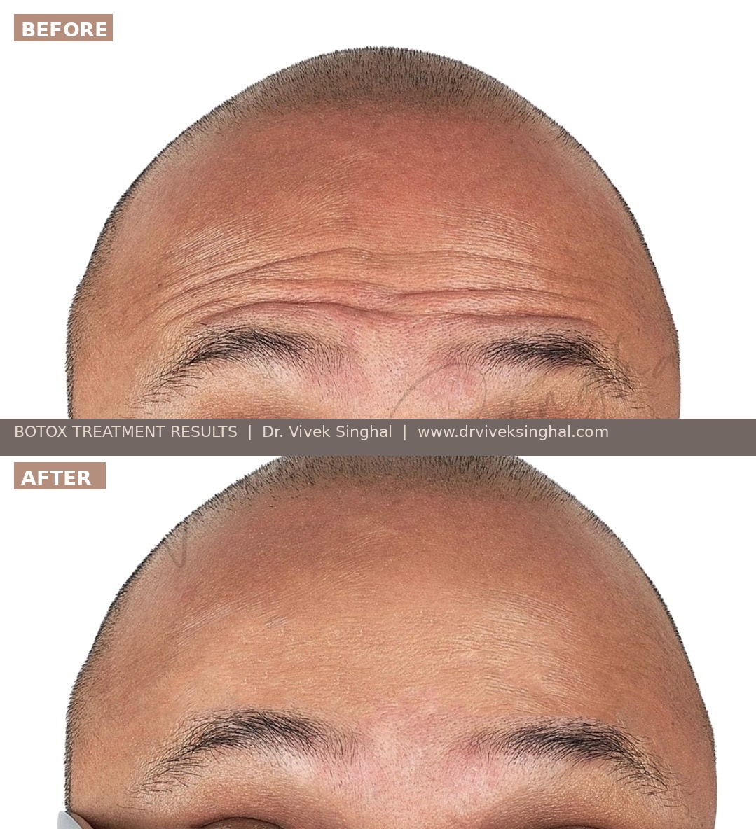 botox-male-before-after-dr-vivek-singhal