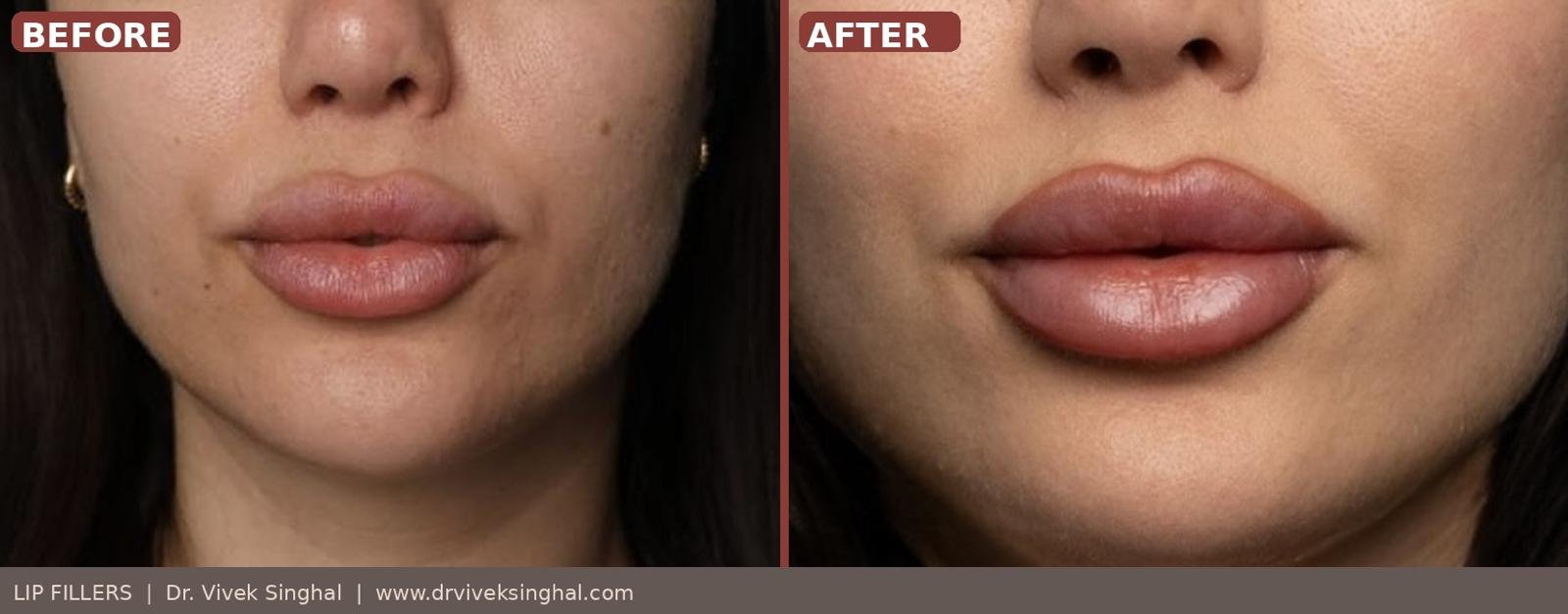 lip fillers