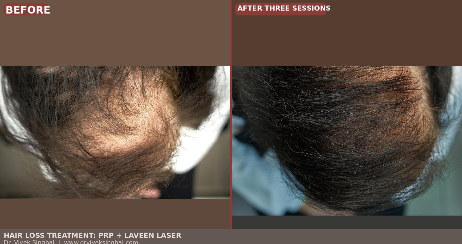 hair loss treatment
