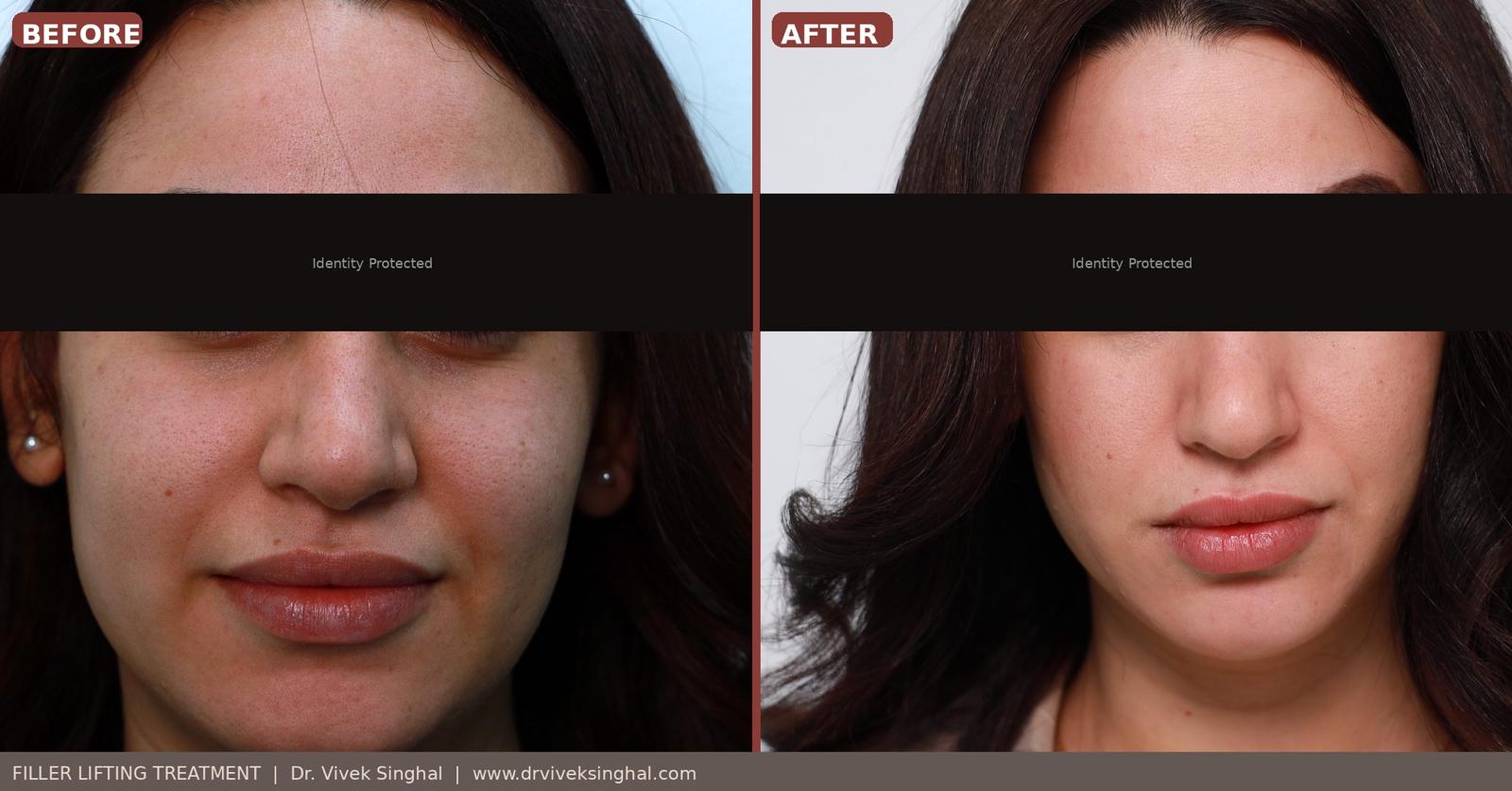 fillers for facial lifting