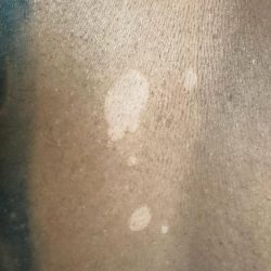 Skin disorders